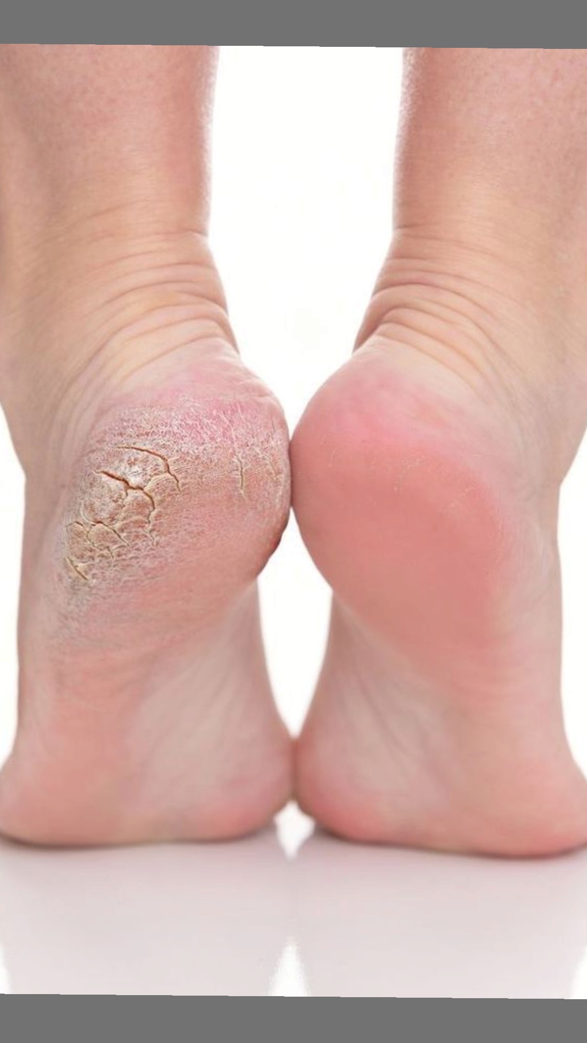 Cracked Heel Treatment