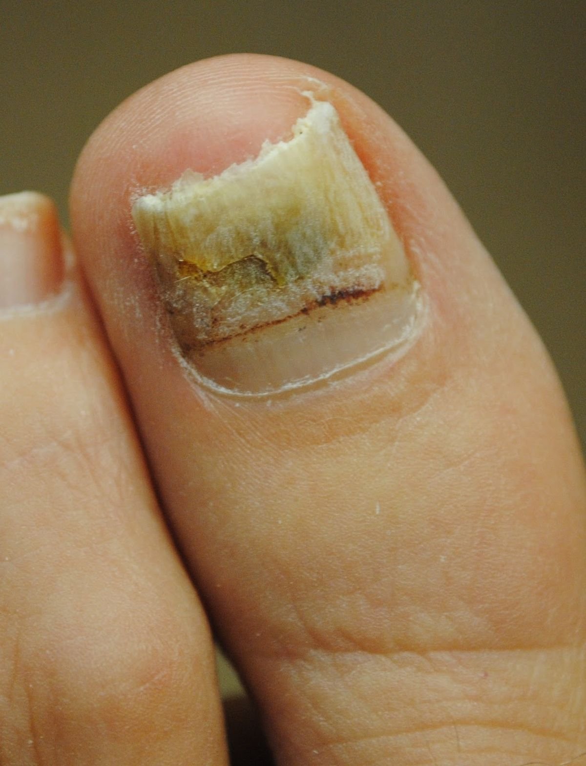 Thickened Nail Treatment