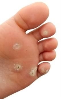 Verruca Treatment